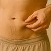 Acupuncture for weight loss