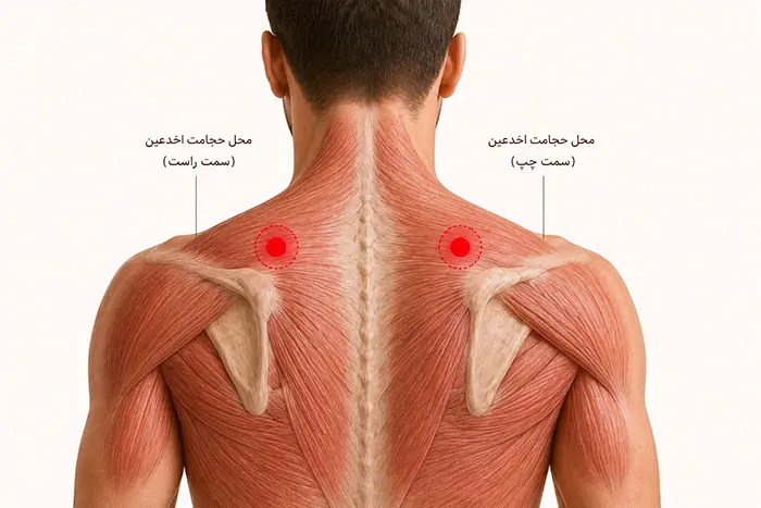حجامت اخدعین